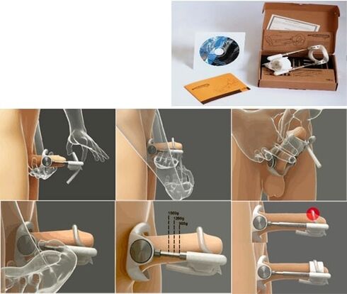 Увеличение пениса с помощью экстендера